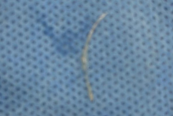 Fish bone removed from throat by Dr. Shruti Sharma, an experienced ENT Specialist in (Pedder Road and Tardeo) Mumbai for diagnosing and treating disorders related to the ear, nose, and throat.