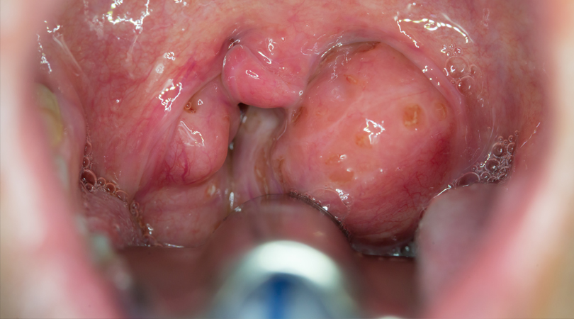 Dr. Shruti Sharma, ENT specialist doctor is trained and qualified to perform tonsillectomy, medical procedure, at (Pedder Road and Tardeo) Mumbai.