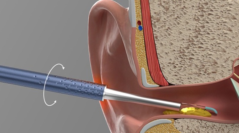 Dr. Shruti Sharma, is the best ENT specialist doctor for earwax removal at (Pedder Road and Tardeo) Mumbai.
