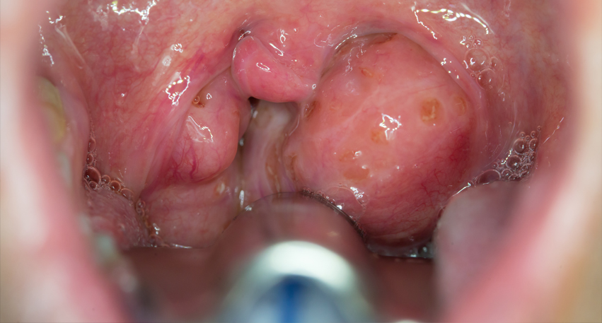 Dr. Shruti Sharma, ENT specialist doctor is trained and qualified to perform tonsillectomy, medical procedure, at (Pedder Road and Tardeo) Mumbai.