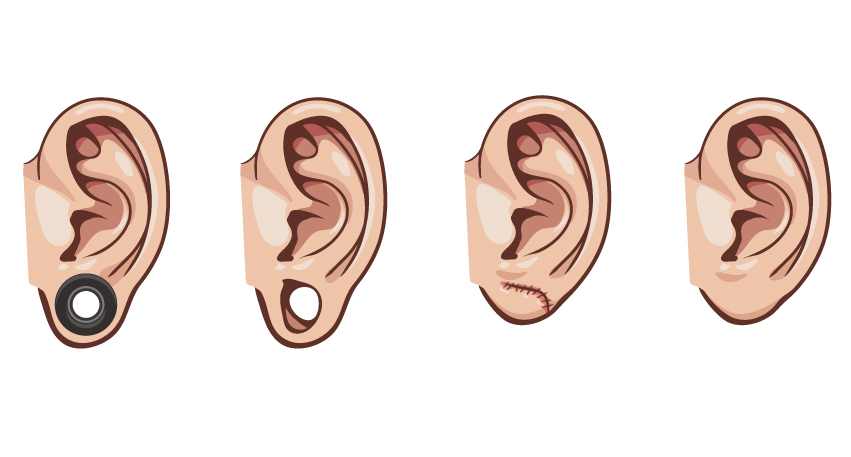 Dr. Shruti Sharma, ENT specialist doctor is trained and qualified to perform earlobe reconstruction or earlobe repair surgery at (Pedder Road and Tardeo) Mumbai.
