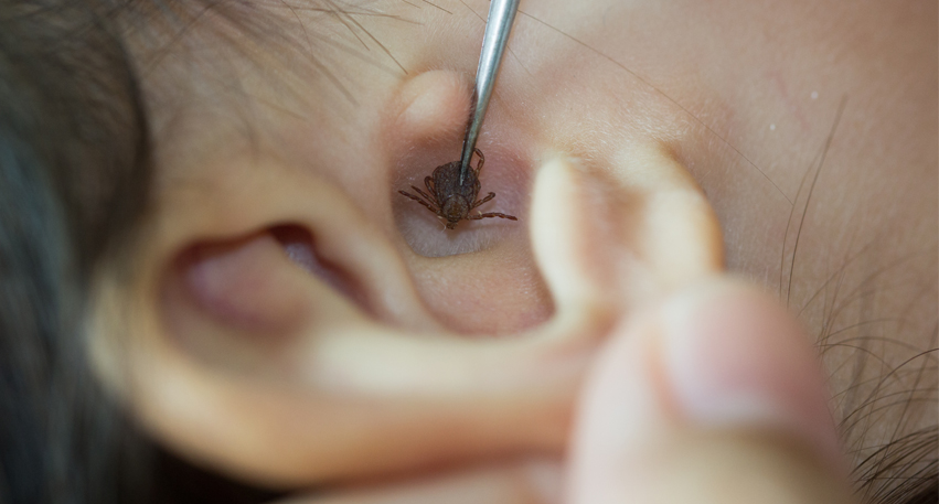 Dr. Shruti Sharma, is the best ENT specialist doctor, for removal of Foreign bodies, entered into ear, nose or throat, at (Pedder Road and Tardeo) Mumbai.
