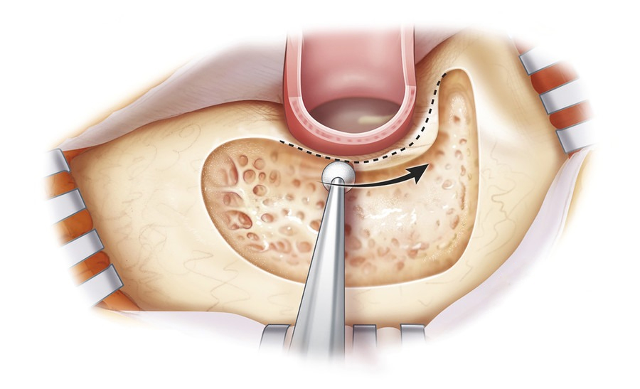 Dr. Shruti Sharma, ENT specialist doctor is trained and qualified to perform mastoidectomy, medical procedure, at (Pedder Road and Tardeo) Mumbai.