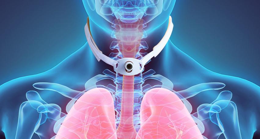 Dr. Shruti Sharma, ENT specialist doctor is trained and qualified to perform Tracheostomy, medical procedure, at (Pedder Road and Tardeo) Mumbai.